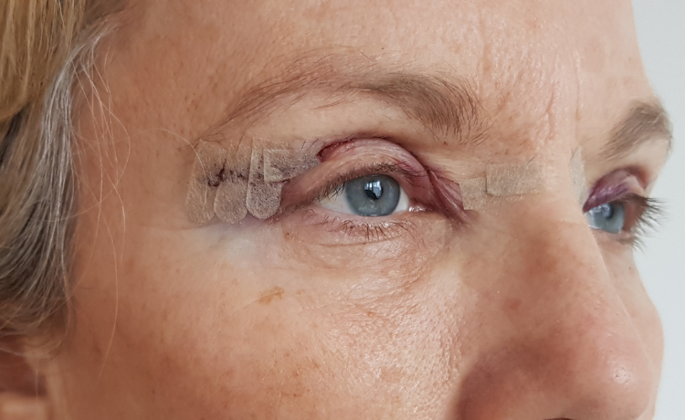 Blefaroplastyka – plastyka powiek