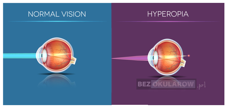 Grafika obrazująca normalne widzenie oraz nadwzroczność. 