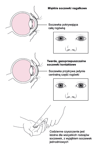 soczewki twarde a miekkie - pielęgnacja