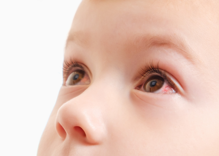 Ropiejące oczy u dziecka