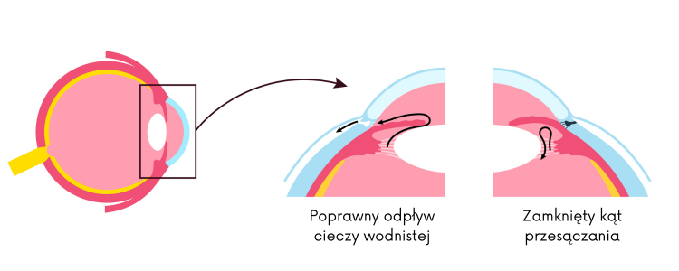 Czym jest jaskra pierwotnie zamkniętego kąta?