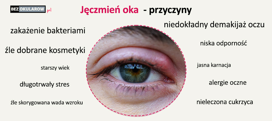 J czmie Oka Jakie S Przyczyny Objawy I Leczenie J czmie Oka Jakie S Przyczyny Objawy I Leczenie