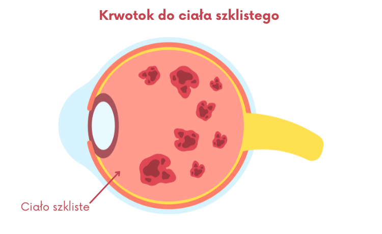 krwotok do ciała szklistego