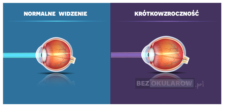 schemat gałki ocznej porównujący zdrowe oko do oka z krótkowzrocznością