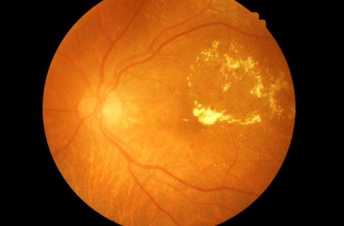 retinopatia cukrzycowa