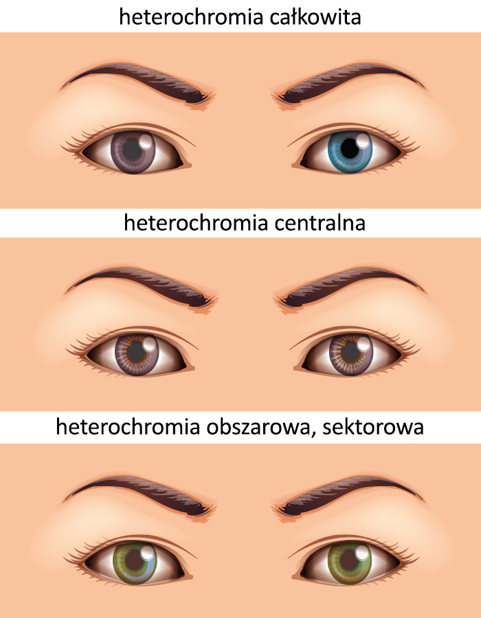 rodzaje heterochromia inforgrafika