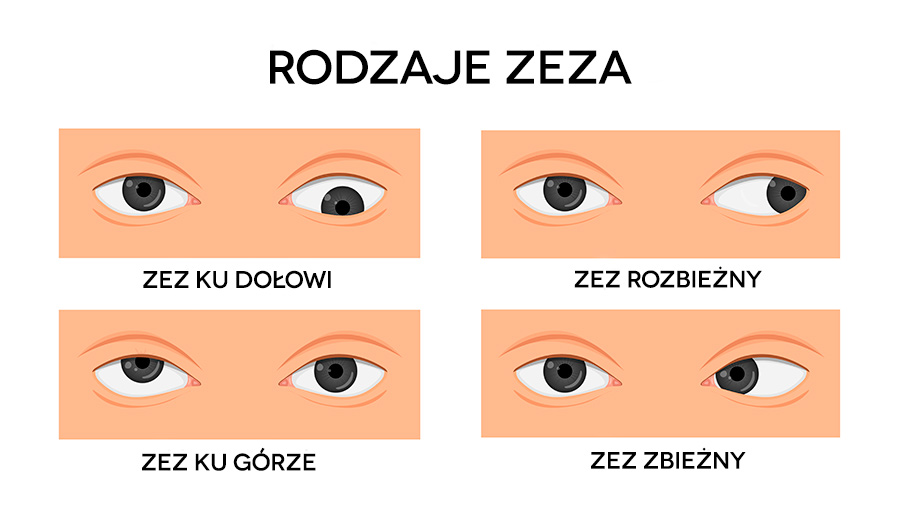 Co To Jest Zez Rodzaje I Leczenie Zeza Poradnikzdrowiepl Porn Sex Picture