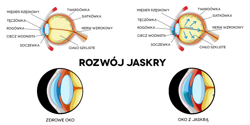 rozwój jaskry przekrój oka